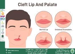 مقالة علمية بعنوان (( A cleft palate)) 