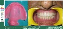 Meatus obturator