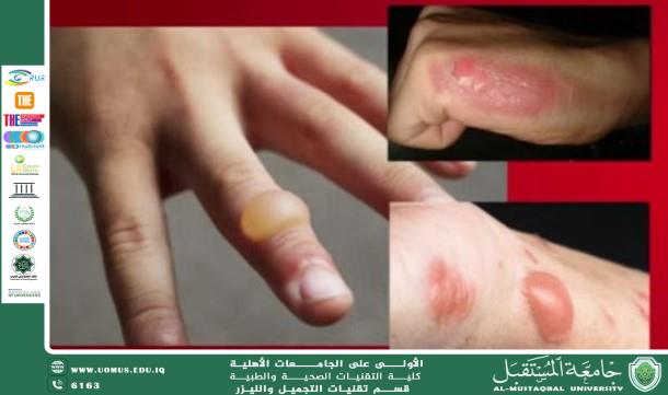 مقاله علميه للتدريسيه م.م هيمن وليد مظلوم بعنوان توظيف الليزر في علاج الحروق الحاصلة في جسم الانسان