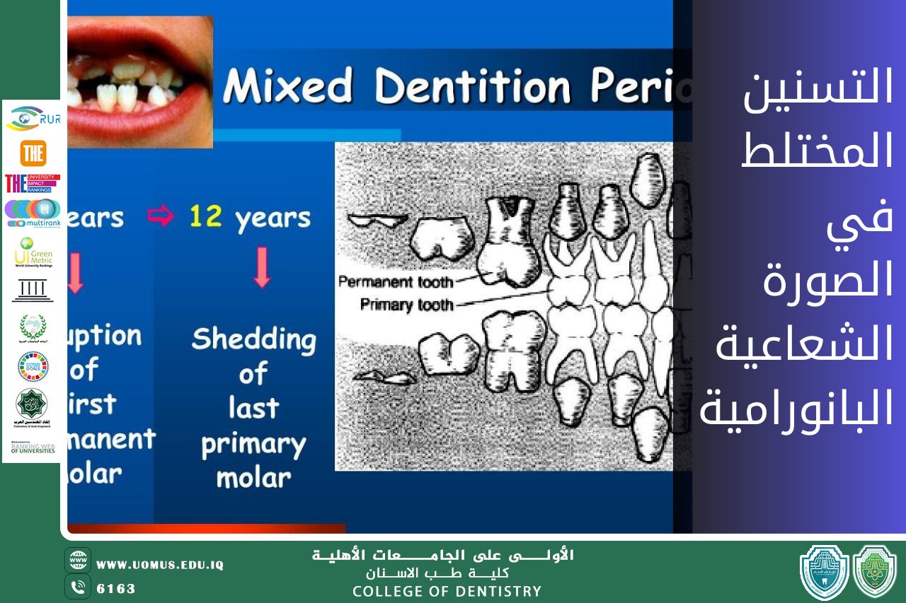 مقالة علمية للدكتورة نور فتحي بعنوان "التسنين المختلط في الصورة الشعاعية البانورامية".