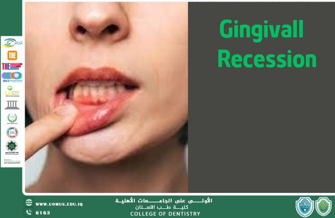 A new scientific article by Dr. Zaid Muhannad titled "Gingival Recession"