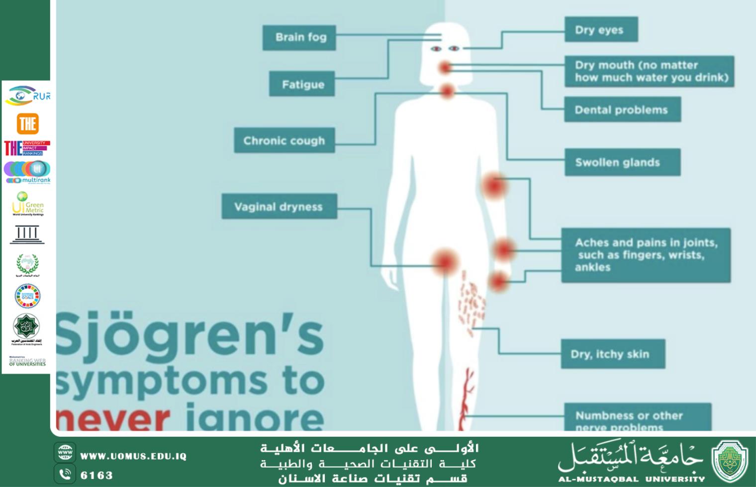 مقالة علمية للاستاذ الدكتور ( منى صالح مرزة ) (( متلازمة سجوجرن والتهاب المفاصل الروماتويدي )) 
