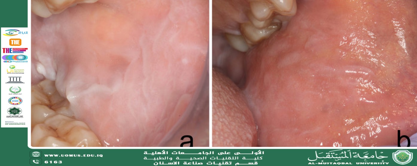 Leukoedema