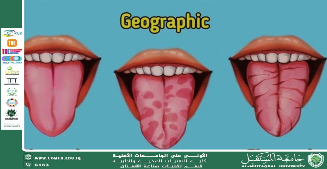 Fissured Tongue
