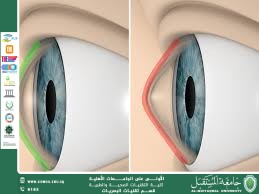 مقالة علمية للتدريسي م.م. علاء محمد عبد العباس بعنوان (القرنية المخروطية ).