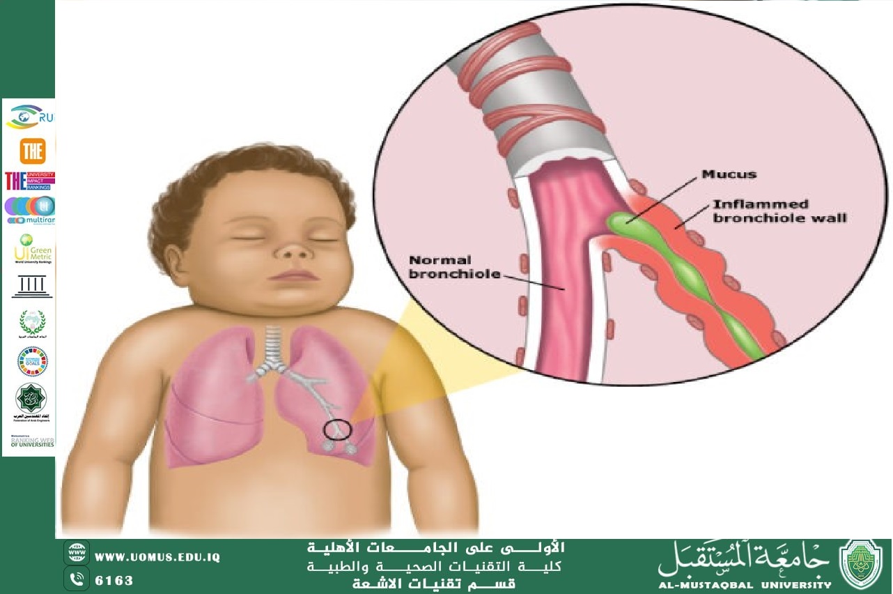 An article entitled "Bronchiolitis" by Dr. Fadhel Sahib