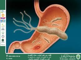 مقاله علميه للست هدى رافد عبد الخالق بعنوان جرثومة المعدة المزمنة: العدو الصامت في الجهاز الهضمي