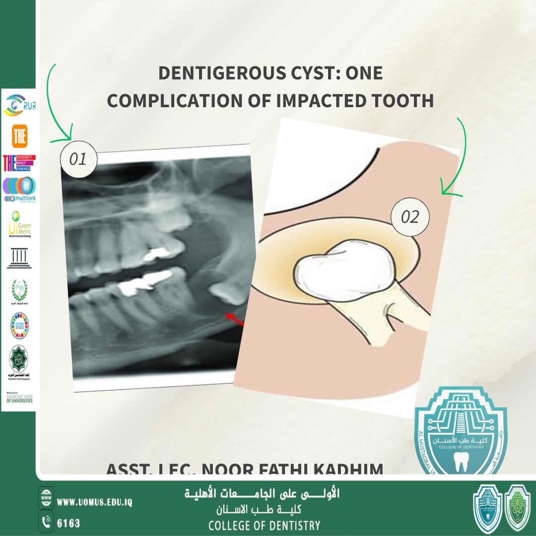 مقالة علمية جديدة للتدريسي م.م نور فتحي كاظم بعنوان " Dentigerous cyst: One complication of impacted tooth " 
