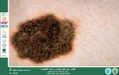 مقالة بعنوان دراسة تجمع بين علاجين مناعيين (كابوزانتينيب ونيفولوماب) لعلاج مرضى الميلانوما المتقدمة أو سرطان الخلايا الحرشفية في الرأس والعنق