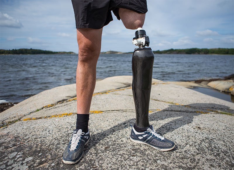  Osseointegrated Prosthetics A Transformative Leap in Limb Replacement