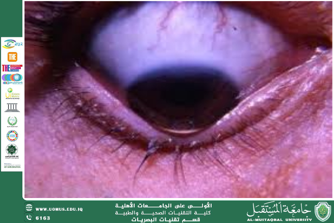  A scientific article by the lecturer, : Dr. Ghaith Ali Mahmoud (Keratoconus 1)