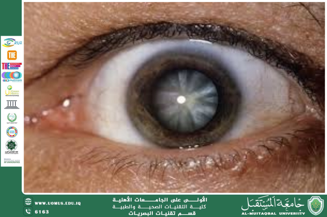  A scientific article by the lecturer, Lect. Ali Hadi Al-Husseini (Aphakia (Absence of the Crystalline Lens)