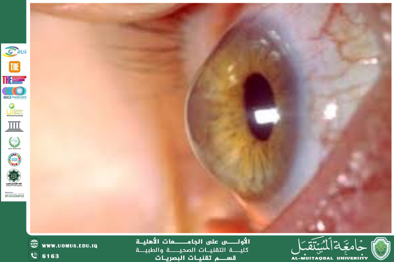  A scientific article by the lecturers, : Asst. Lecturer Marwan Hisham Mohammed (The Importance of Corneal Thickness Measurement in Patients with Elevated Intraocular Pressure)