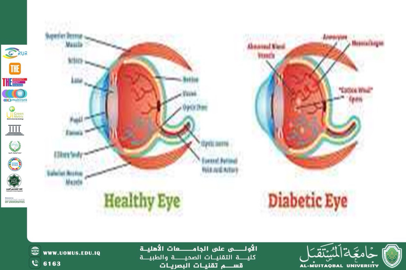  A scientific article by the lecturer, Ms. Nour Khamis (The Effect of Sugars on the Retina)