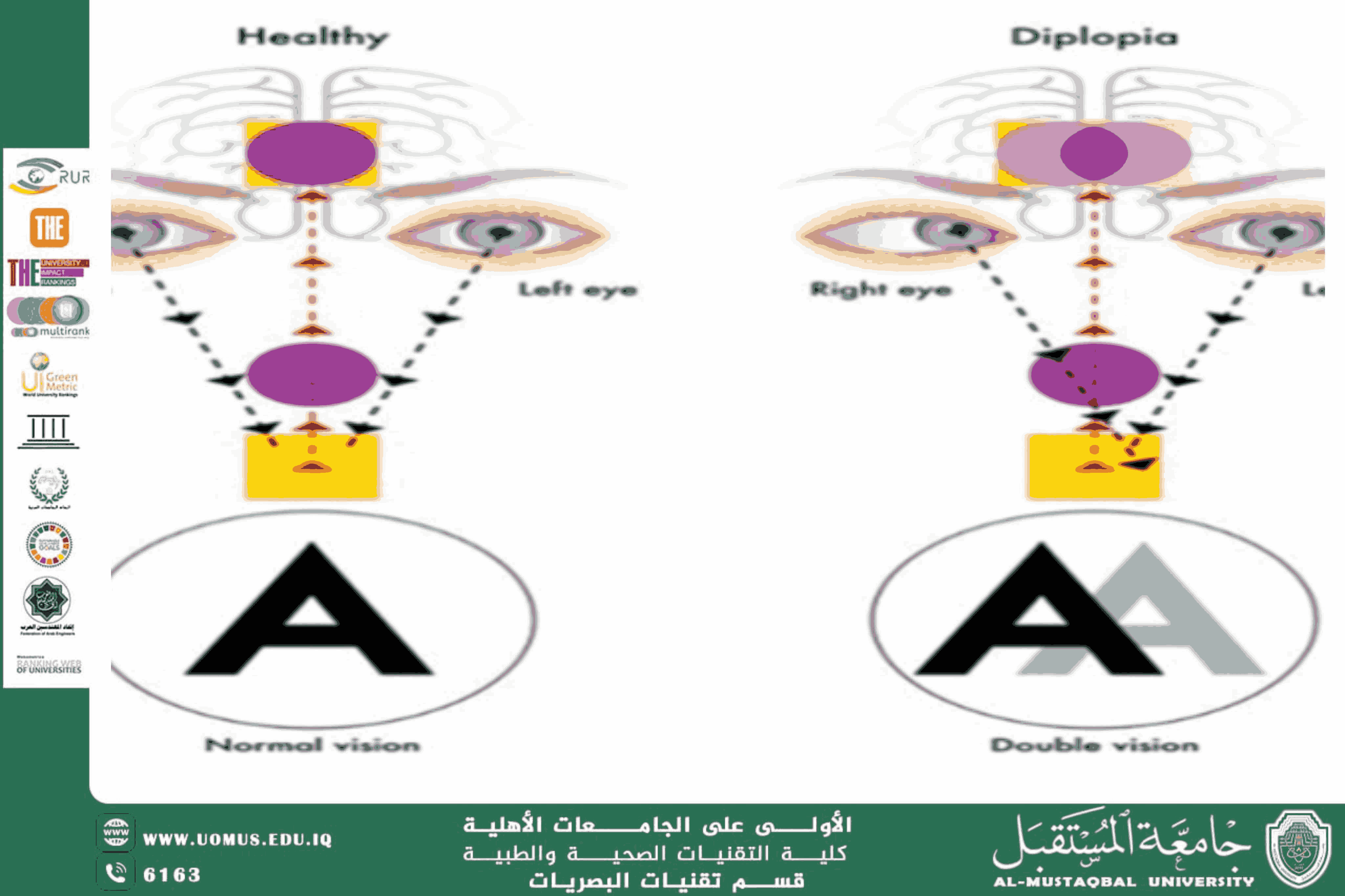  A scientific article by the lecturers, Assist.Prof.Dr. Munther Sameen Shukur / dr. Ibtehal Noori/Lect. Mohaimen Sameer Aref (Under Standing Double Vision Treatment Physically.)