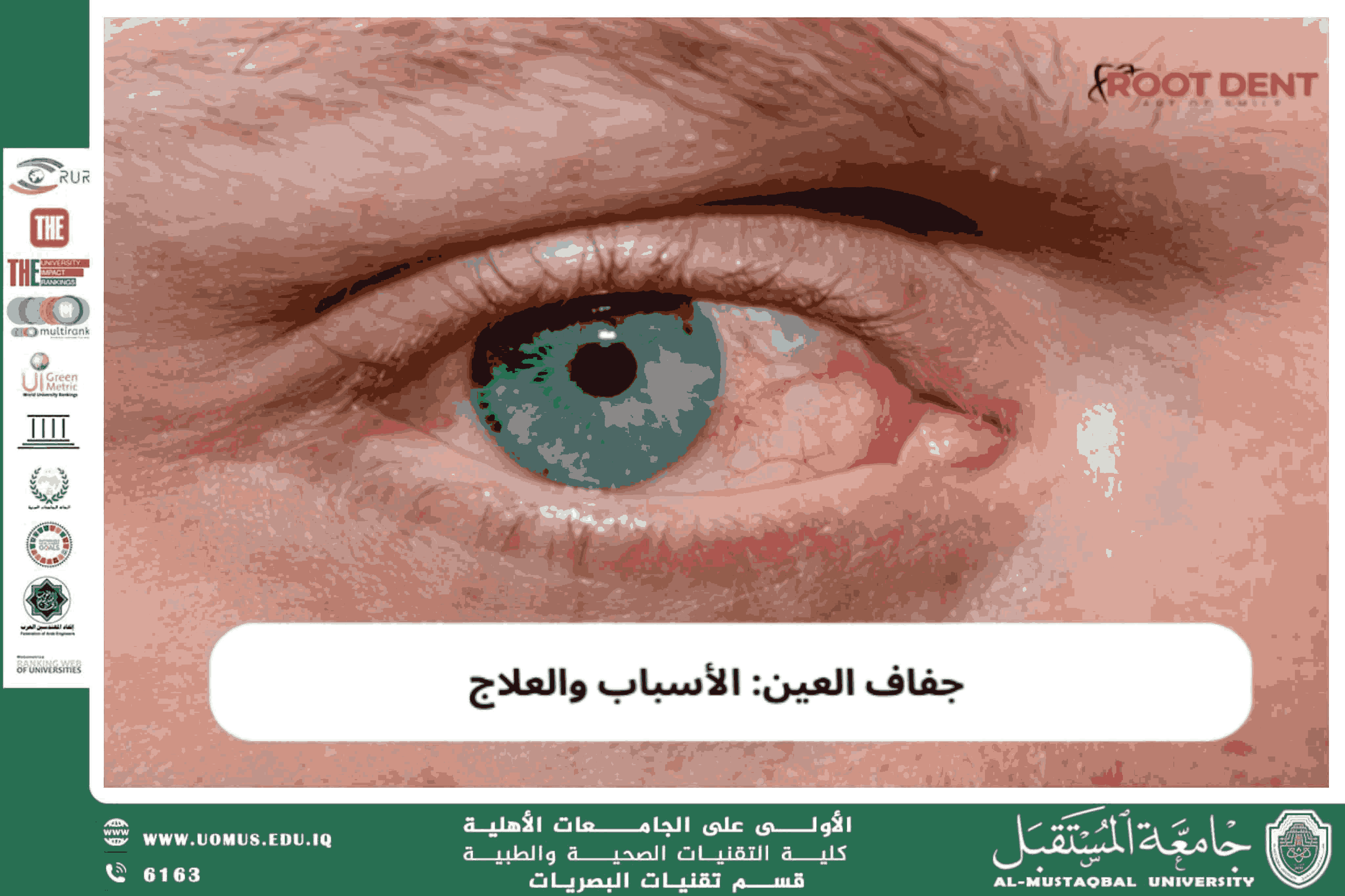  A scientific article by the lecturers, Assist.Prof.Dr. Munther Sameen Shukur (Causes of Dry Eye)
