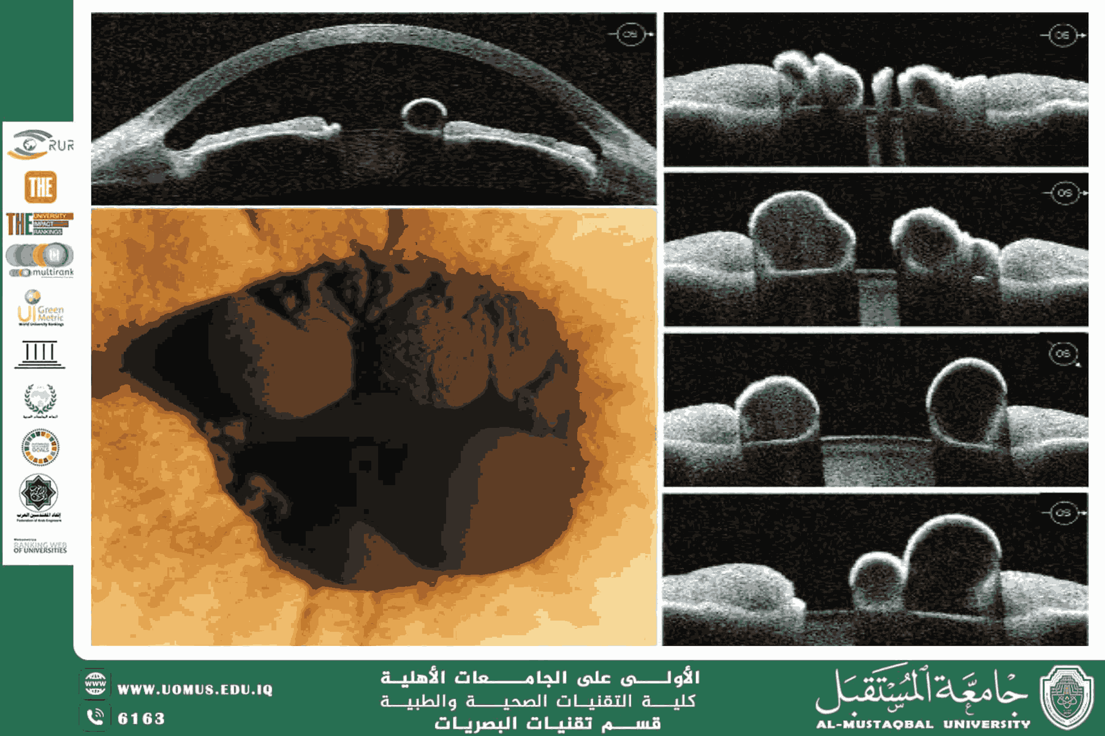  A scientific article by the lecturer, Asst. Lecturer Hassan Qahtan Kazem Al-Hussein (Optical Coherence Tomography: An Early Window into Systemic Diseases)
