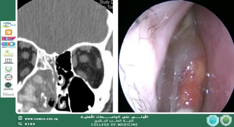 مقالة بعنوان  التهاب الجيوب الأنفية الفطري التحديات في التشخيص والعلاج