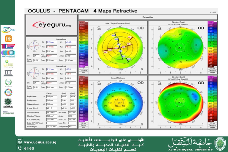 A scientific article by Assistant Lecturer Mohaimen Sameer Aref titled ( Clinical Applications of Corneal Topography Maps in Diagnosing Refractive Disorders)