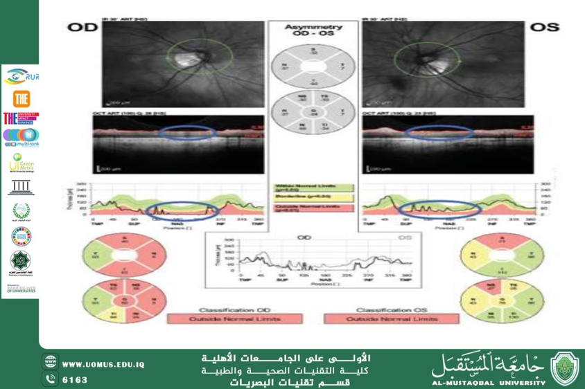 A scientific article by Assistant Lecturer Mohaimen Sameer Aref titled ( The Role of Optical Coherence Tomography (OCT) in Early Detection of Glaucoma)