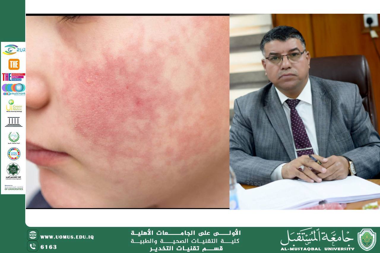 مقالة للدكتور احمد خضير الحميري عن الحصبة الألمانية (Rubella)