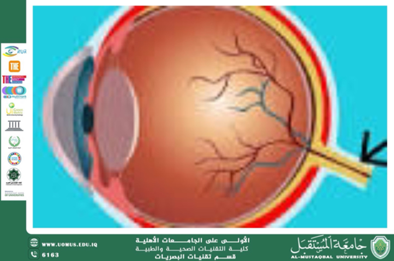 A scientific article by Author Hassan Abd Ali titled (Vision Therapy in the Management of Strabismus and Amblyopia in Children)