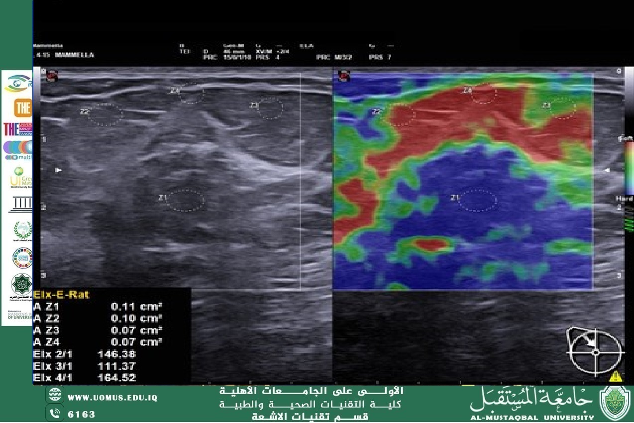 مقالة بعنوان : " الموجات فوق الصوتية الطبية: من التصوير التقليدي إلى التصوير المرن (Elastography) " للتدريسي ضرغام يوسف